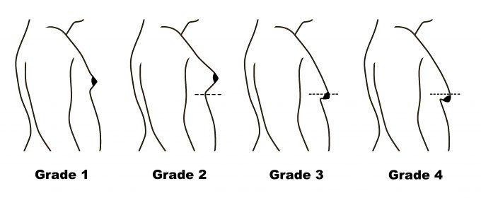 Liposuction dada pria Gynecomastia