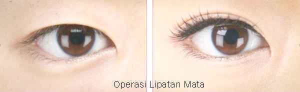 Operasi Lipatan mata ganda