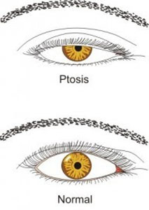 Blepharoplasty Jakarta - Ptosis