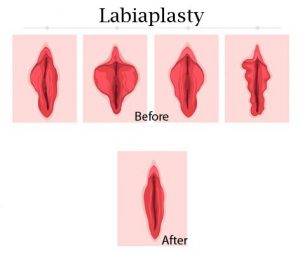 merapikan bibir vagina labiaplasty