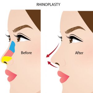 Operasi memancungkan hidung Rhinoplasty