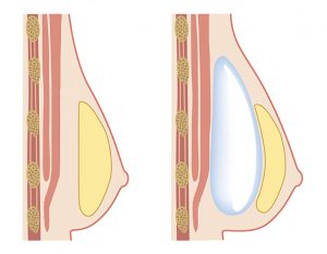 Augmentasi payudara dengan implant