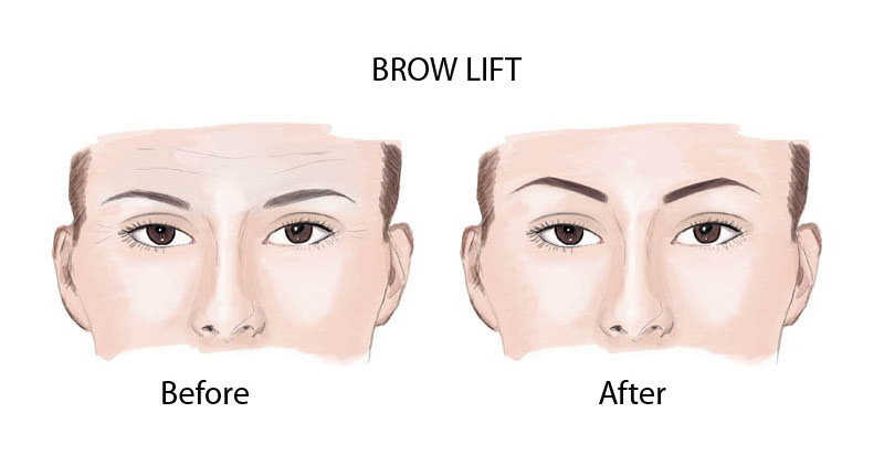 operasi browlift