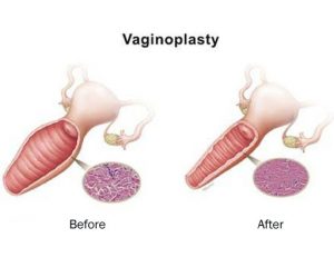 Vaginoplasty mengencangkan vagina