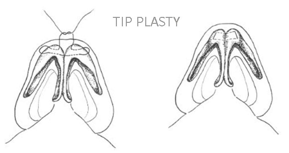 Membentuk ujung hidung dengan TIP PLASTY