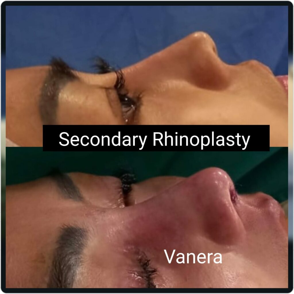 Secondary rhinoplasty  - pasien menginginkan perbaikian hidung paska operasi di dokter lain. Hasil secondary rhinoplasty terlihat lebih natural 