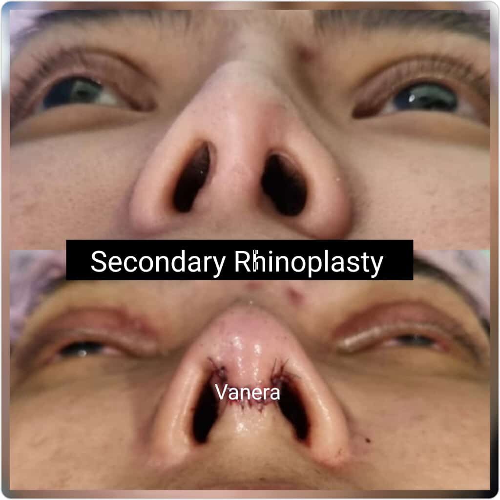 Operasi revisi hidung - Secondary rhinoplasty. Pasien menginginkan untuk memperbaiki batang hidung dan columella hidung yang terlihat miring pasca operasi di dokter lain dengan implant dan tulang rawan telinga.  